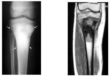 Osteosarkom Röntgen