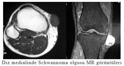 Diz medialinde Schwannoma olgusu MR görüntüleri