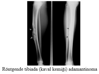Röntgende tibiada (kaval kemiği) adamantinoma.