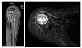 Humerus üst uç anevrizmal kemik kisti MR görüntüsü