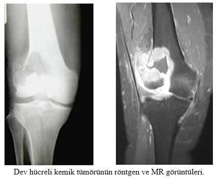 Dev hücreli Kemik Tümör
