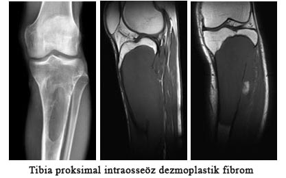 Tibi proksimal intraosseöz dezmoplastik fibrom