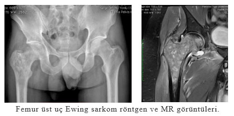 Ewing sarkom röntgeni