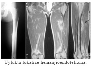 Uylukta lokalize hemanjioendotelioma