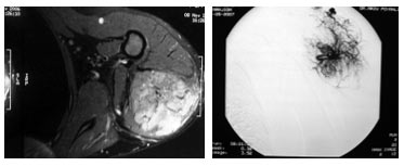 Omuz posteriorunda lokalize hemanjiom MR ve anjiyografi