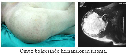 Omuz bölgesinde hemanjioperisitoma