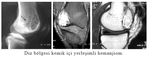 Diz bölgesi kemik içi yerleşimli hemanjiom