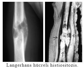 Langerhans hücreli histiositozis