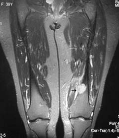 İntraosseöz Osteosarkom