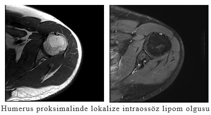 Humerus proksimalinde lokalize intraossöz lipom olgusu