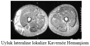 Uyluk lateraline lokalize Kavernöz Hemanjiom