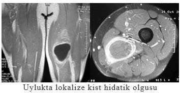 Uylukta lokalize kist hidatik olgusu