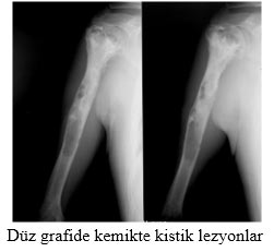 Düz grafide kemikte kistik lezyonlar