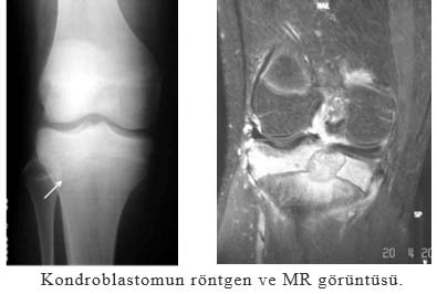 Kondroblastomun Rontgen