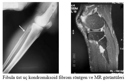 Kondromiksoid fibrom röntgen 
