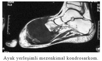 Ayak yerleşimli mezenkimal kondrosarkom