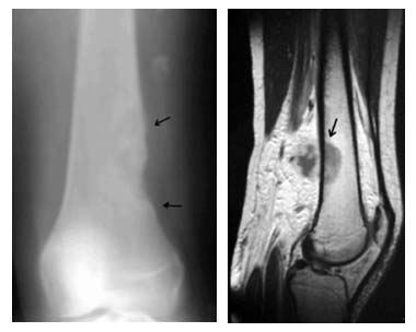 Küçük Hücreli Osteosarkom