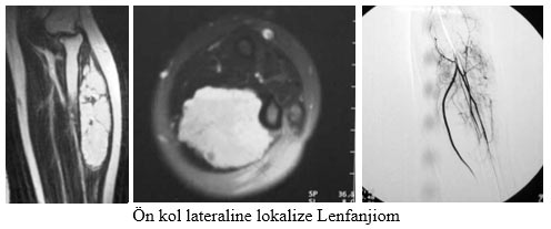 Ön kol lateraline lokalize Lenfanjiom