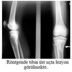 Röntgende tibia üst uçta lezyon görülmekte