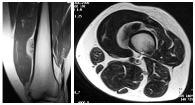 Uyluk yerleşimli Mezenkimal kondrosarkom olgusunun MR görüntüleri