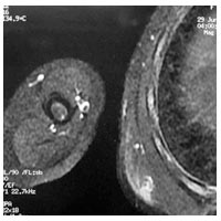 Alveoler Rabdomiyosarkom