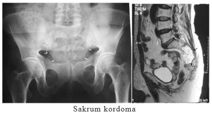 Sakrum kordoma