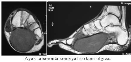 Ayak tabanında sinovyal sarkom olgusu