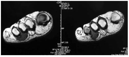 Ayak parmak fleksör tendon kaynaklı dev hücreli tendon tümörü olgusu